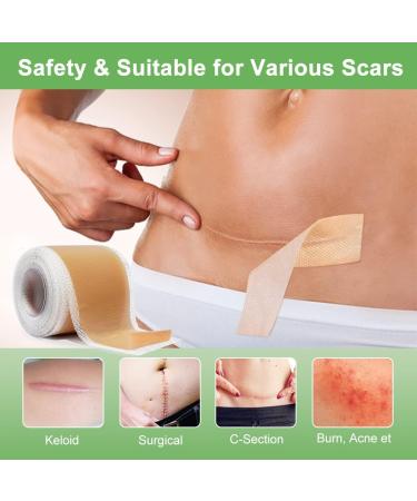 Silicone Scar Sheets 4.6cm x 4m | Medical Grade Scar Tape