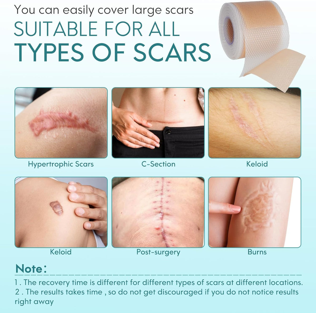 Silicone Scar Sheets 4.6cm x 4m | Medical Grade Scar Tape