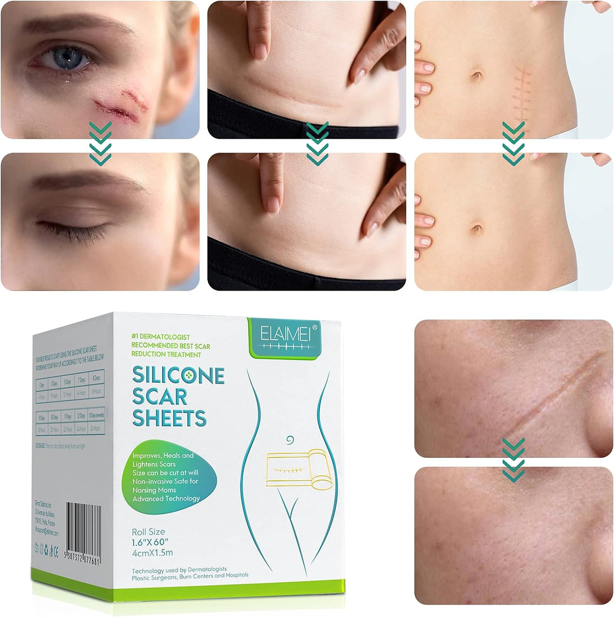 Silicone Scar Sheet 4cm x 1.5m | Medical Grade Scar Removal Tape